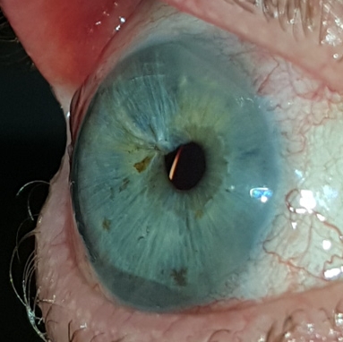 20190421_184708_Reflex_IOL.jpg